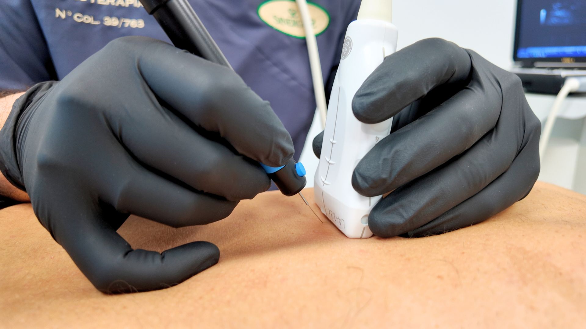 Tratamiento con electro punción ecoguiada en mompia de Ander Santa Coloma